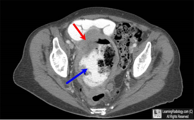 Small bowel lymphoma